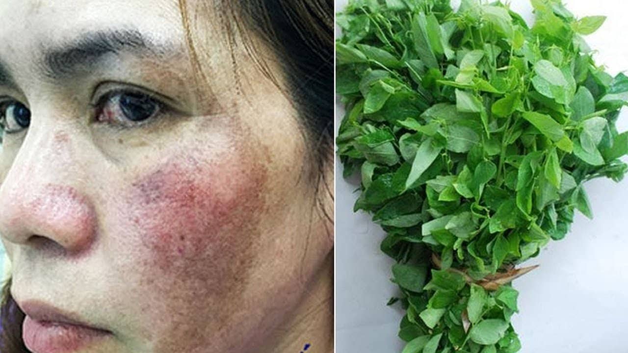 Cách làm mờ nám da bằng rau ngót, hiệu quả bất ngờ sau 7 ngày 5 cach-lam-mo-nam-da-tu-rau-ngot-1
