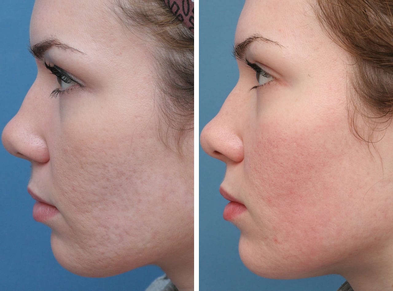 Thưa bác sĩ, trị sẹo rỗ giá bao nhiêu năm 2018? 4 ket-qua-tri-seo-ro-bang-cong-nghe-fractional-co2-laser-nam-2018-2