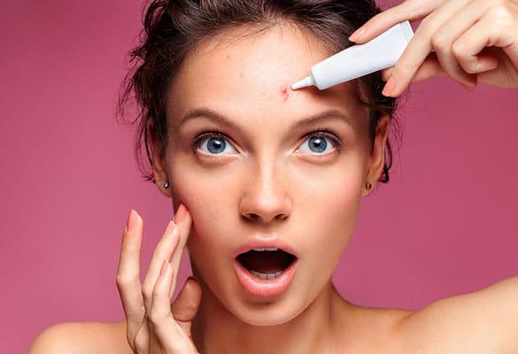 Chăm sóc da mùa hè - Phải bắt đầu từ đâu? 14 Trang bị sẵn cho mình một "bảo bối" trị mụn kề cạnh bên vào mùa hè, nhằm kịp thời chặn đứng sự lây lan của mụn