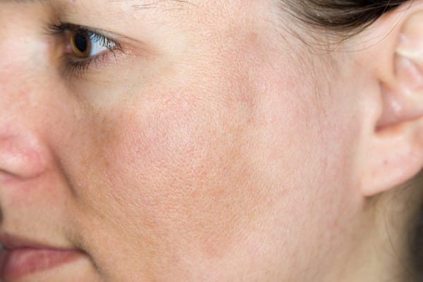 Cận cảnh quy trình điều trị nám da công nghệ laser tại Cosmedical Clinic 4 muon-tri-nam-ma-thi-quy-trinh-dieu-tri-nhu-the-nao