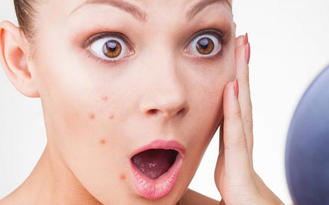 Mụn bọc khiến da sưng đỏ - Có cách nào điều trị? 5 kham pha 4 loai mat na tri mun boc tai nha duoc bac si khuyen dung
