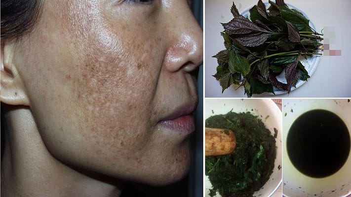 Cách điều trị nám da hiệu quả từ lá tía tô,7 ngày nám mờ hẳn, bạn đã thử chưa? 5 cach-dieu-tri-nam-da-hieu-qua-bang-tia-to1