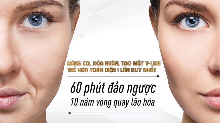 NÂNG CƠ XÓA NHĂN KHÔNG PHẪU THUẬT NÂNG CƠ XÓA NHĂN KHÔNG PHẪU THUẬT BẰNG CÔNG NGHỆ ROCKET VIBA VÀNG
