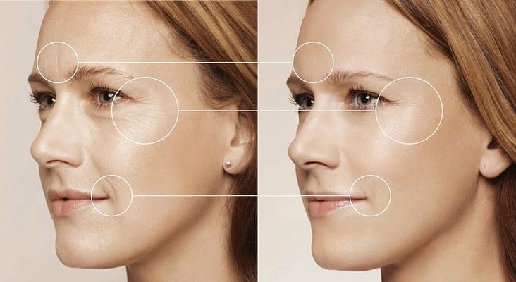 Công nghệ xóa nhăn hiệu quả không phẫu thuật Công nghệ xóa nhăn hiệu quả không phẫu thuật