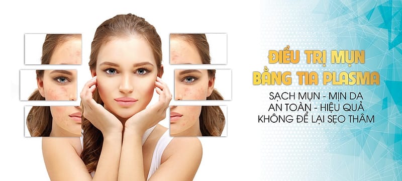 Nguyên nhân và giải pháp điều trị mụn đầu đen hiệu quả 4 Giải pháp điều trị mụn đầu đen bằng Plasma.