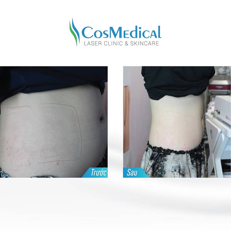 LIỆU TRÌNH GIẢM BÉO SLIMMER LIPO 48 slimer 1 03