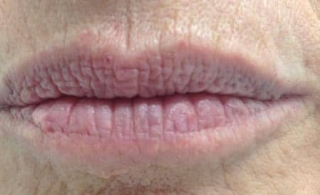 LIP BENEFITS 8 duoc-my-pham-cosmedical-usa-lip-before-3
