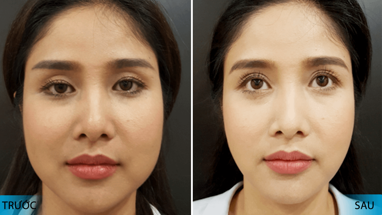LIỆU PHÁP XÓA NHĂN NHƯ BOTOX 19 xoa-nhan-nang-co-macca3t-vuocca3t-trocca3i-trecc89-hon-10-nam-truoc-sau-1-lan-rada-vang-quang-xung-kich-kh-6