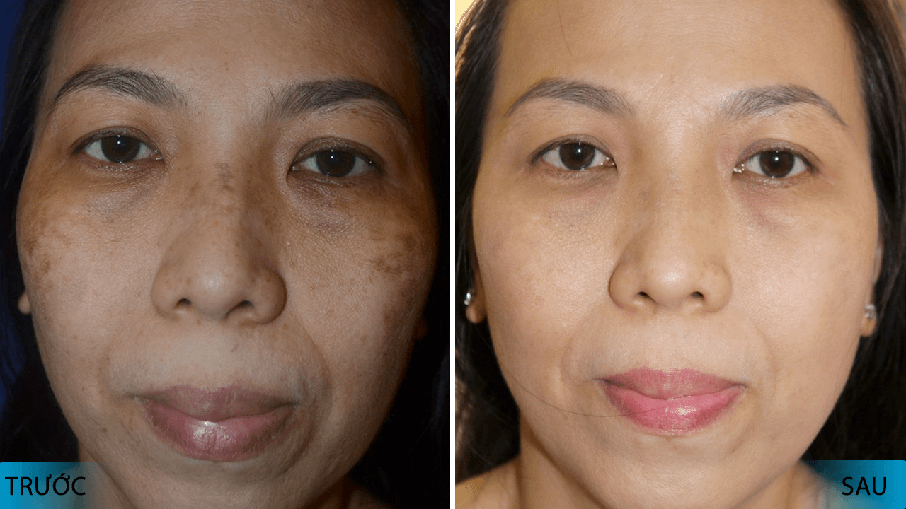 TRỊ NÁM SÂU CÔNG NGHỆ PICOFOUR CỦA MỸ 54 pico-four-ket-hop-laser-pico-toning-va-nano-toning-dang-la-xu-huong-tri-nam-hieu-qua-va-noi-tieng-nhat-kh-6
