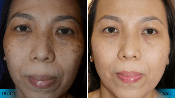Thuốc lột da mặt trị nám có phải là cách làm mờ nám da an toàn, hiệu quả ? 10 thuoc lot da mat co phai la cach lam mo nam da an toan hieu qua 4 e1616986938608