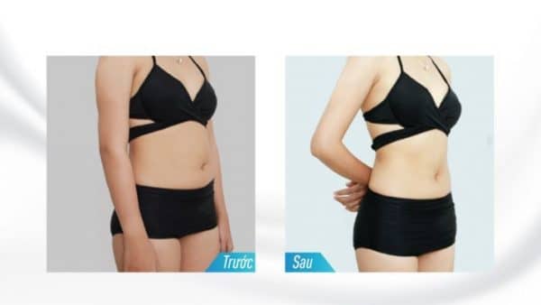 Uống gừng giảm mỡ bụng hiệu quả sau 2 tuần, bạn đã thử chưa? 11 Hình ảnh khách hàng thực tế trước và sau khi giảm béo tại CosMedical Clinic