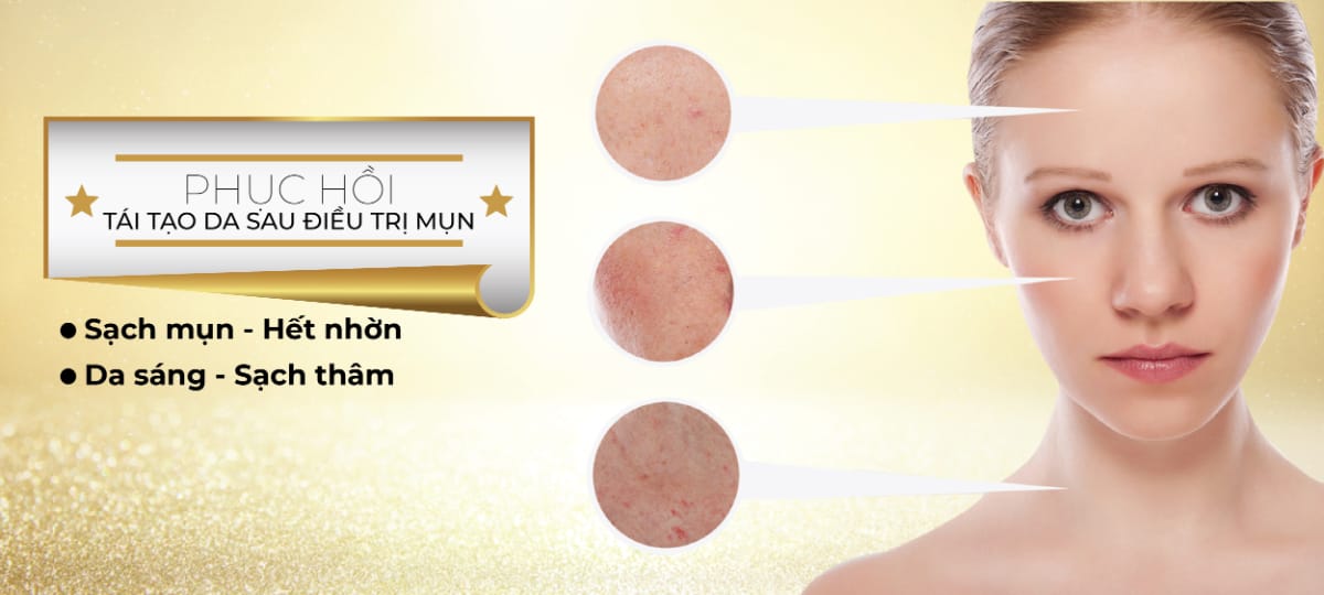 ĐIỀU TRỊ MỤN BẰNG TIA PLASMA 11 Phuc hoi da sau mun