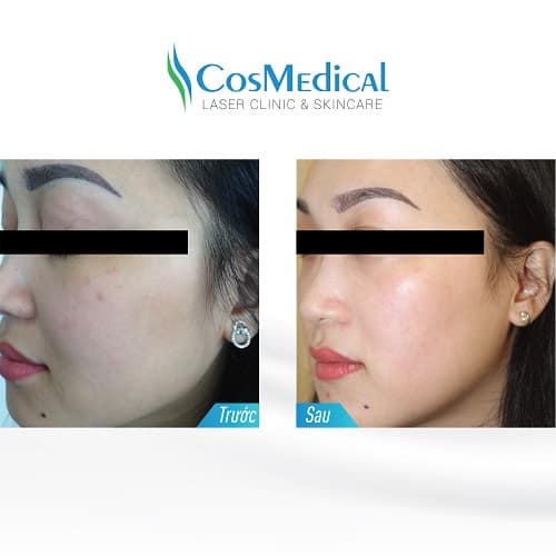 CẤY TẾ BÀO GỐC VÀ COPPER TRIPEPTIDES TÁI TẠO COLLAGEN 13 Cấy Copper Tripeptide