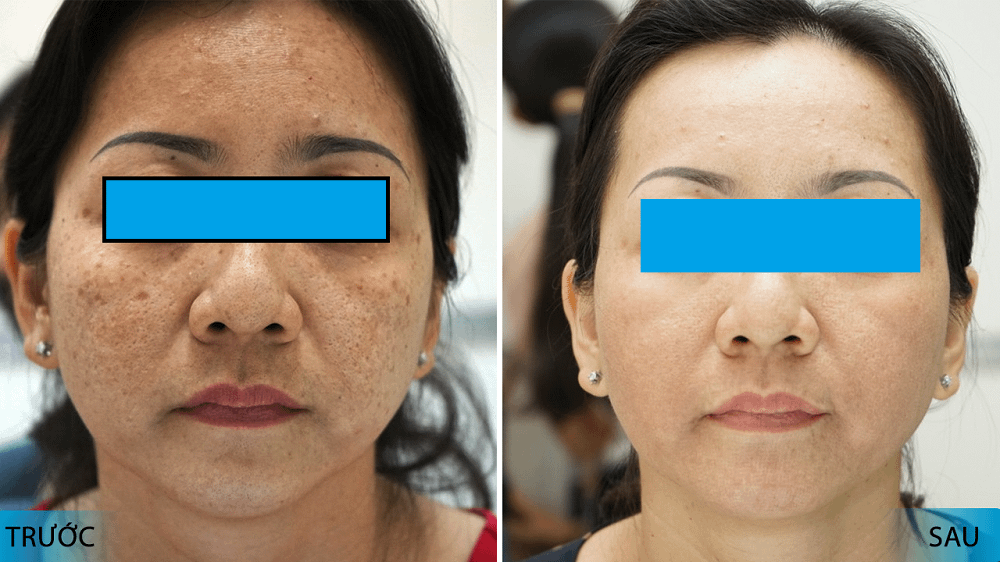 TRỊ NÁM SÂU CÔNG NGHỆ PICOFOUR CỦA MỸ 53 Hình ảnh trước sau trị nám sâu tại trung tâm thẩm mỹ CosMedical Clinic