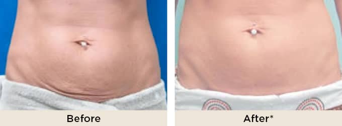 XÓA NHĂN VÙNG BỤNG BẰNG CÔNG NGHỆ PELLEVE (MỸ) 54 PelleFirm3